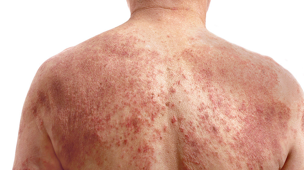 Sve više obolelih od šuge u Novom Sadu