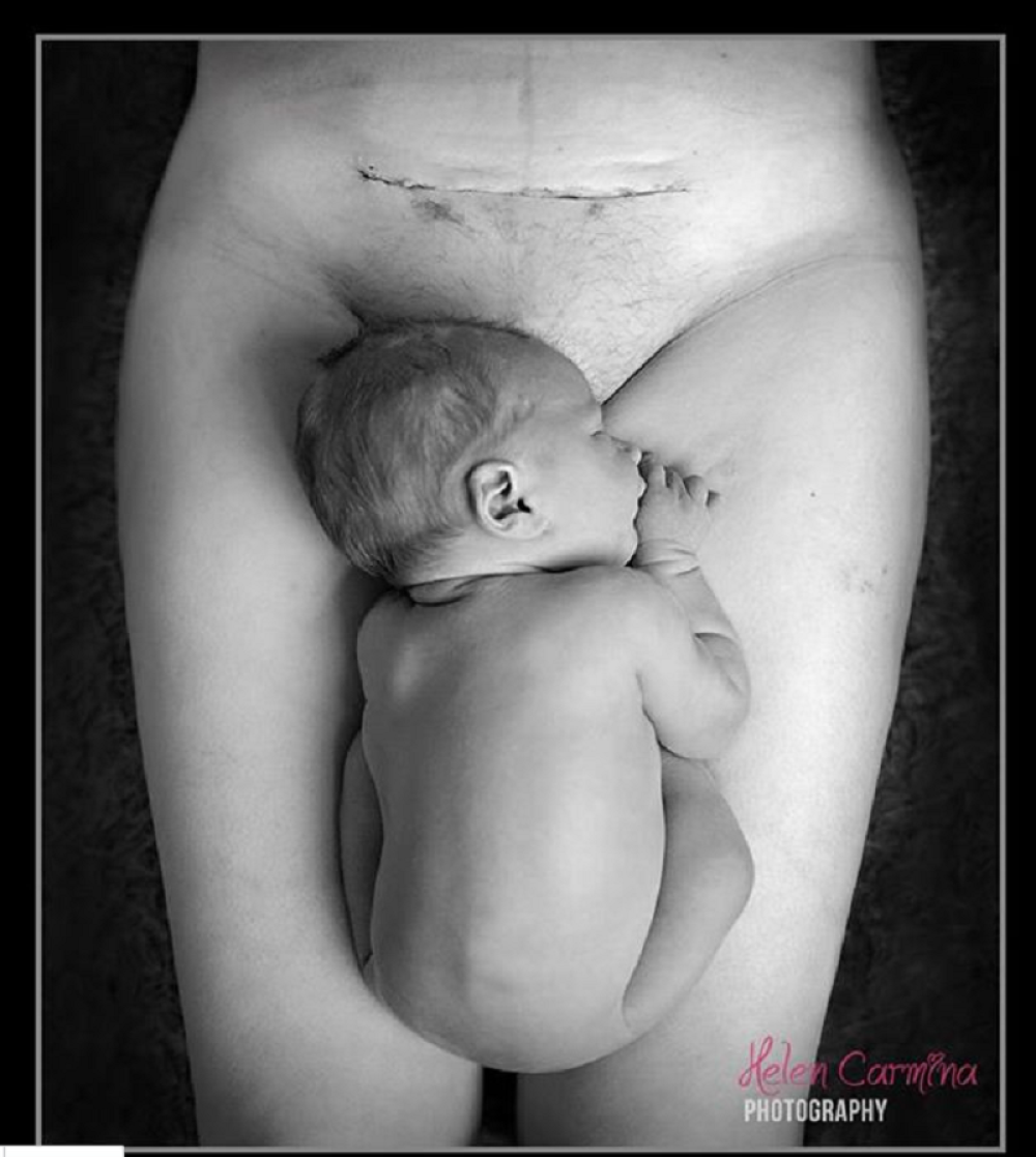 Fotografija majke i bebe posle carskog reza uzburkala društvene mreže (FOTO)