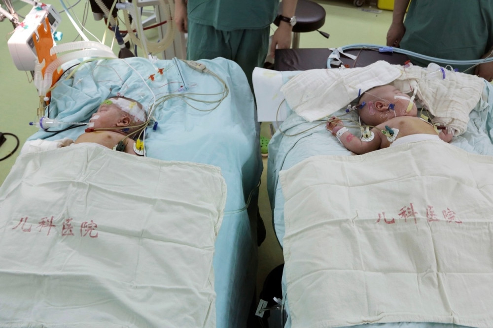 Rođene su kao spojene bliznakinje, svi su mislili da će umreti, a 16 godina kasnije one su ČUDO!