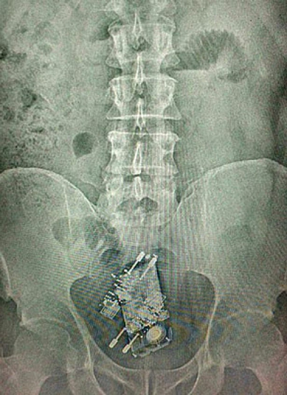 Zatvorenik progutao mobilni i dva punjača!