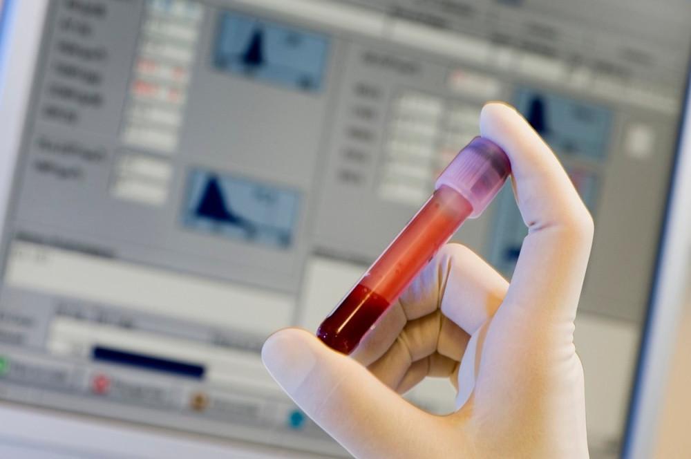 Rešite se masnoće iz krvi uz pomoć samo dva sastojka!