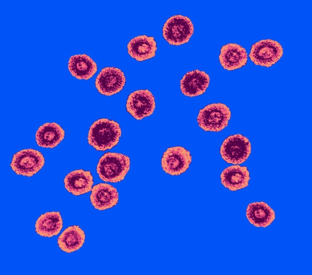 Skoro četiri miijarde ljudi ima virus herpesa!