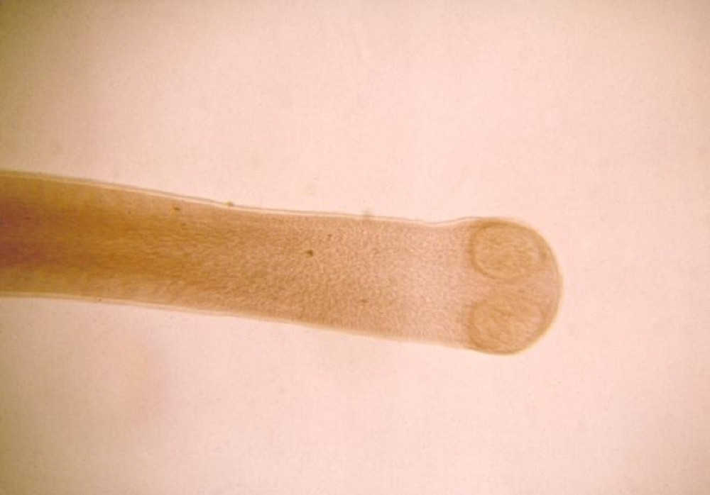 Živog čoveka pojeli crvi!