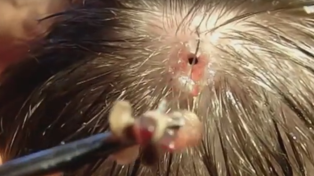 Izvadili mu crva iz lobanje! (UZNEMIRUJUĆI VIDEO)