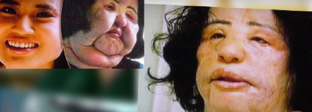 Posle plastičnih operacija ovi ljudi su izgledali zastrašujuće (UZNEMIRUJUĆI VIDEO)