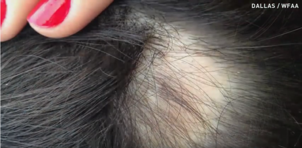 Oćelavile od "fensi" šampona (VIDEO)