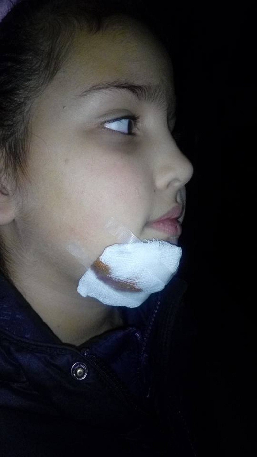 Devojčicu (10) gađali petardom