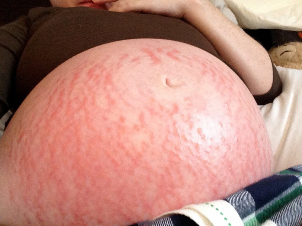 Britanka alergična na trudnoću!