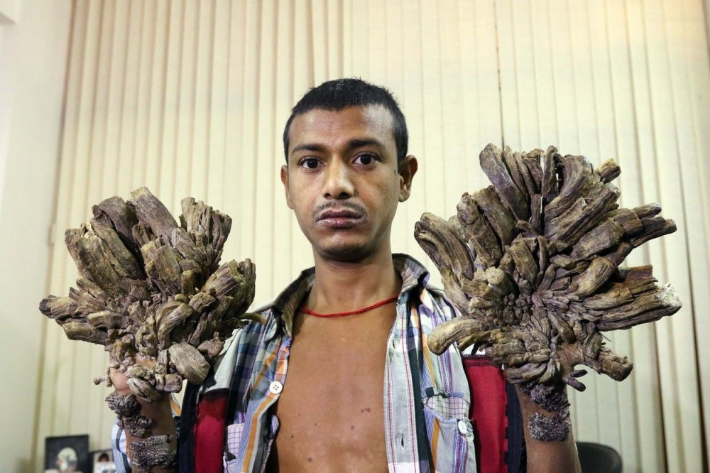 Mladić koji se pretvara u drvo! (FOTO)