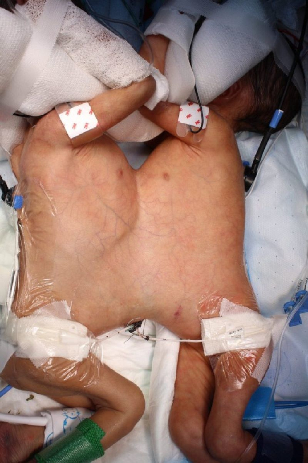 Razdvojene tek rođene sijamske bliznakinje