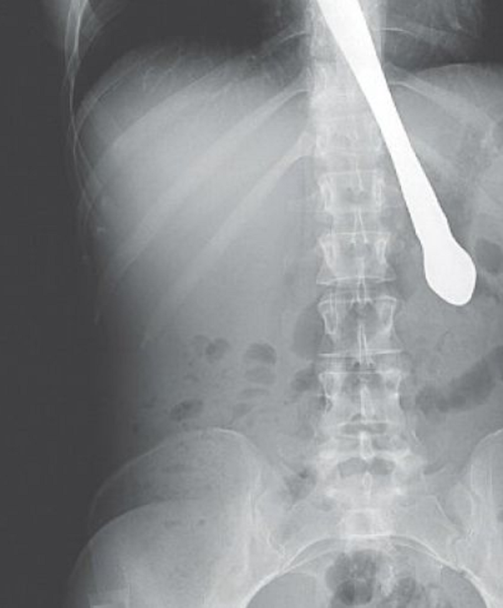 Beograđanin progutao nož dug 36 centimetara!