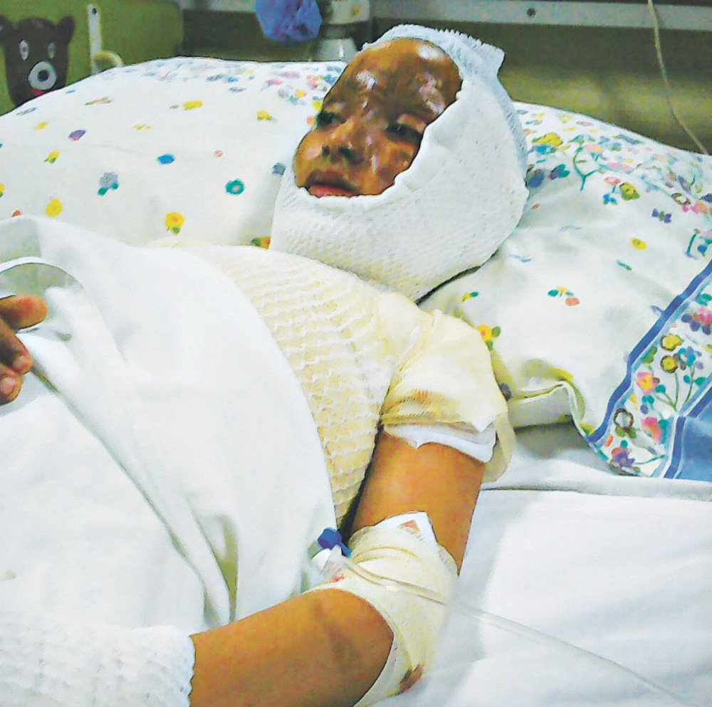 Mališan stabilno, danas presađivanje kože