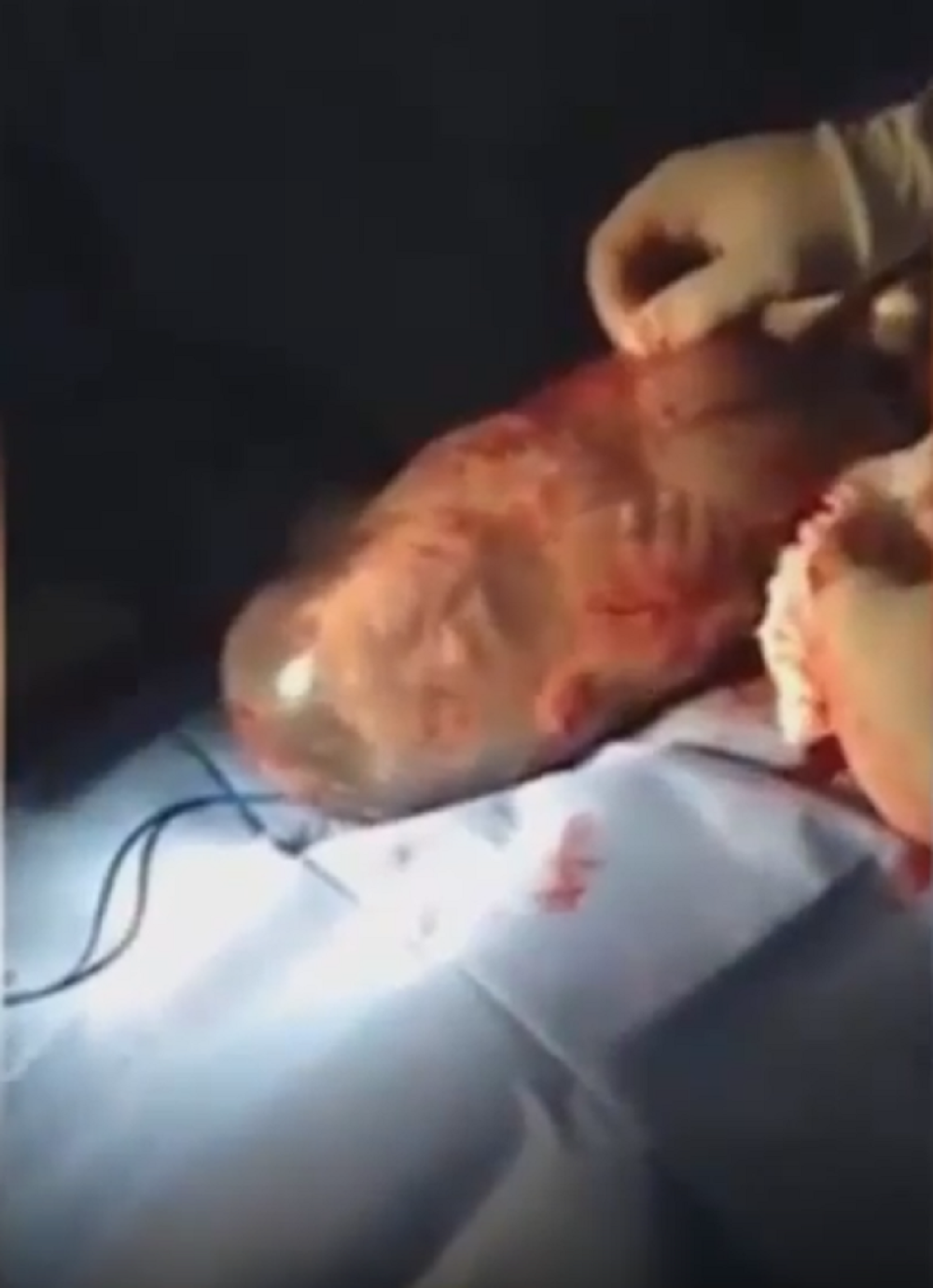 Prvi udisaj bebe rođene sa sve posteljicom! (VIDEO)