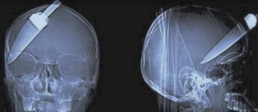 Najčudnije stvari snimljene na rendgenu! (VIDEO)