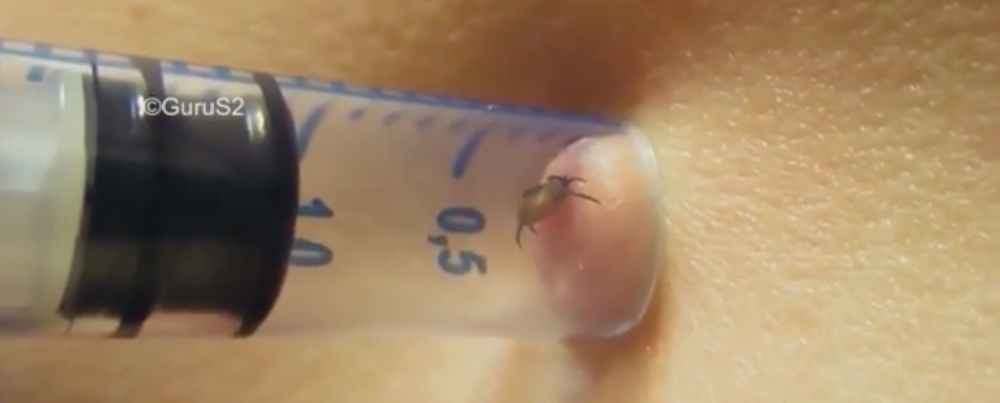 Ovako se pravilno uklanja krpelj! (VIDEO)