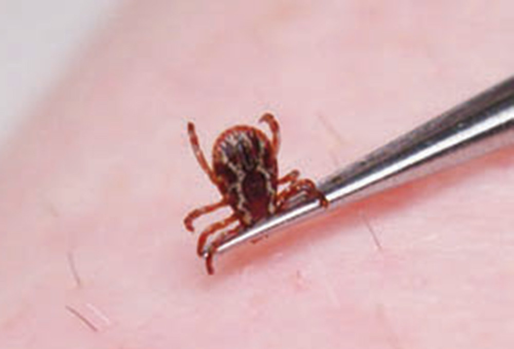 Krpelj joj se zakačio za butinu, a kad je došla kod lekara, doživela šok!