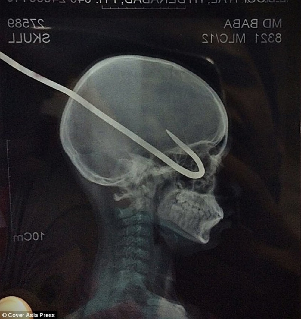 Lekari dečaku izvadili kuku iz oka