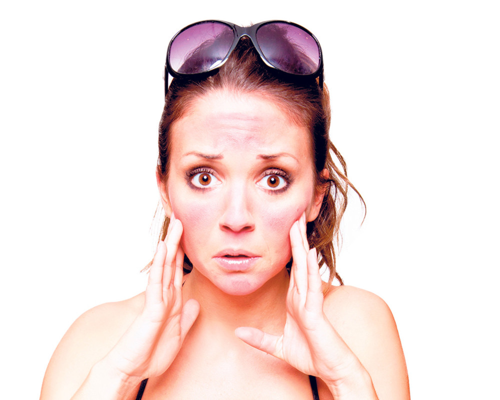 Kako da izlečite opekotina od sunca!