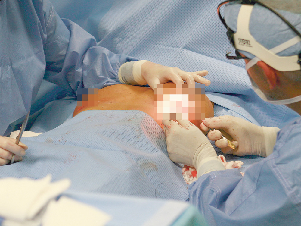 Srpkinje seku dojke kao Anđelina Džoli