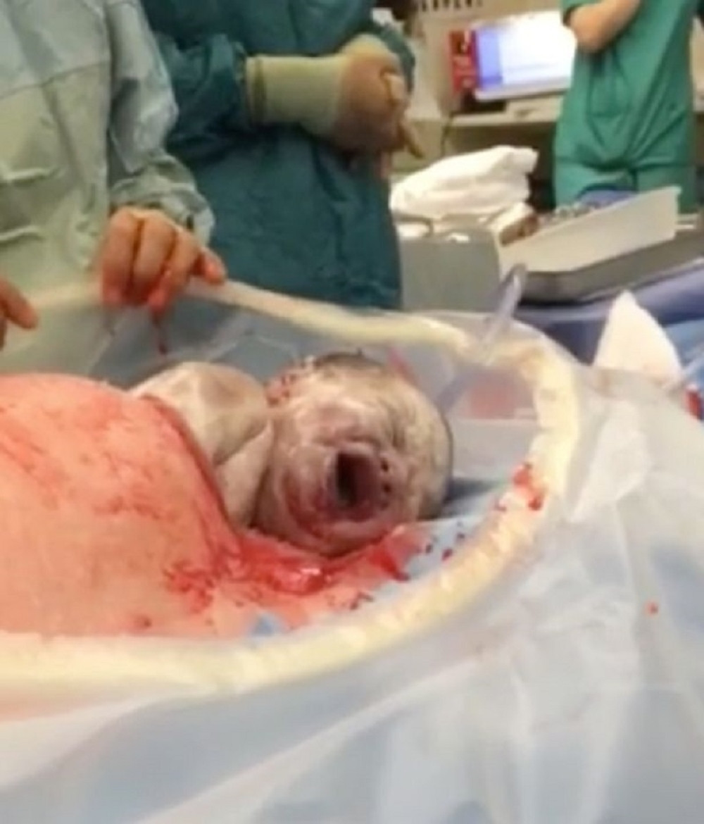 Beba sama izlazi tokom carskog reza (VIDEO + ANKETA)