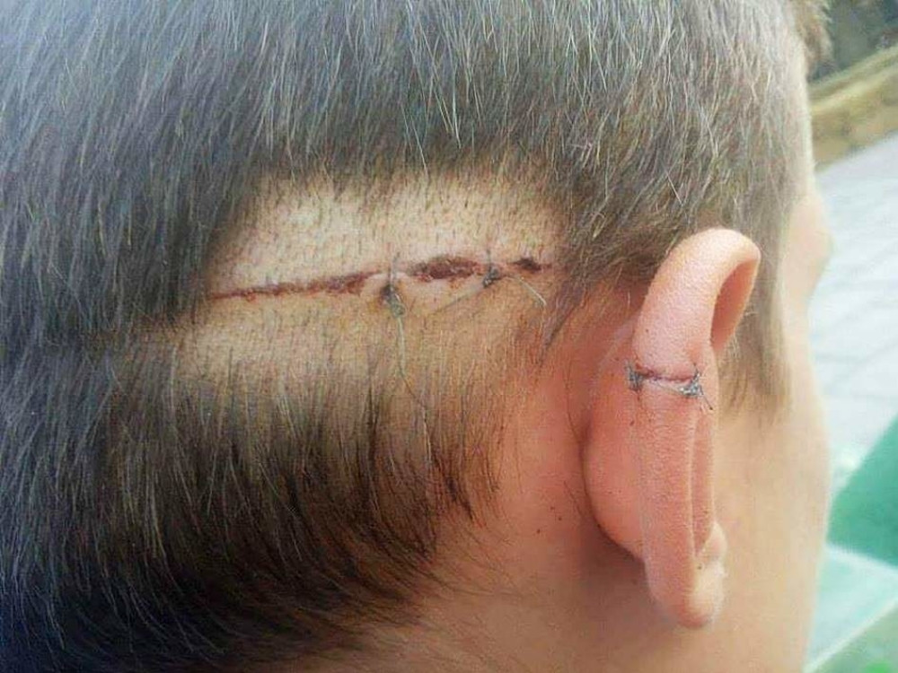 Migrant isekao po glavi dečaka iz Subotice