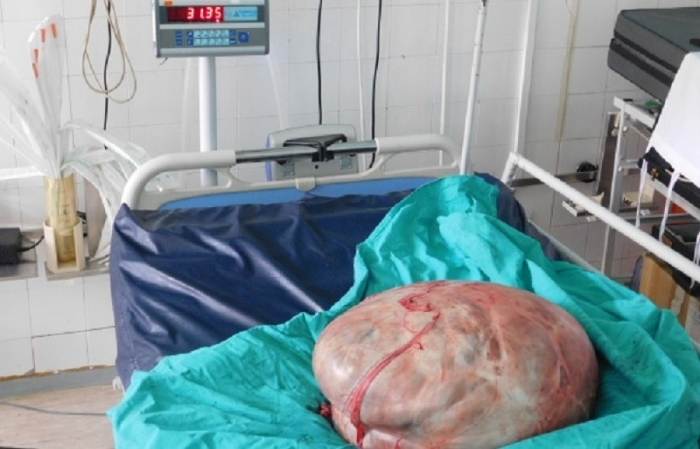 Ženi izvadili tumor od 31 kilograma