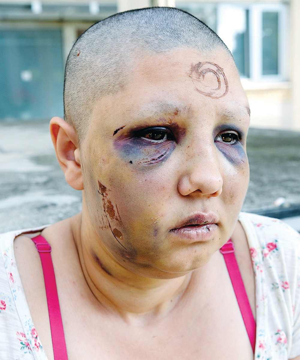 Zabijao mi je eksere u koleno