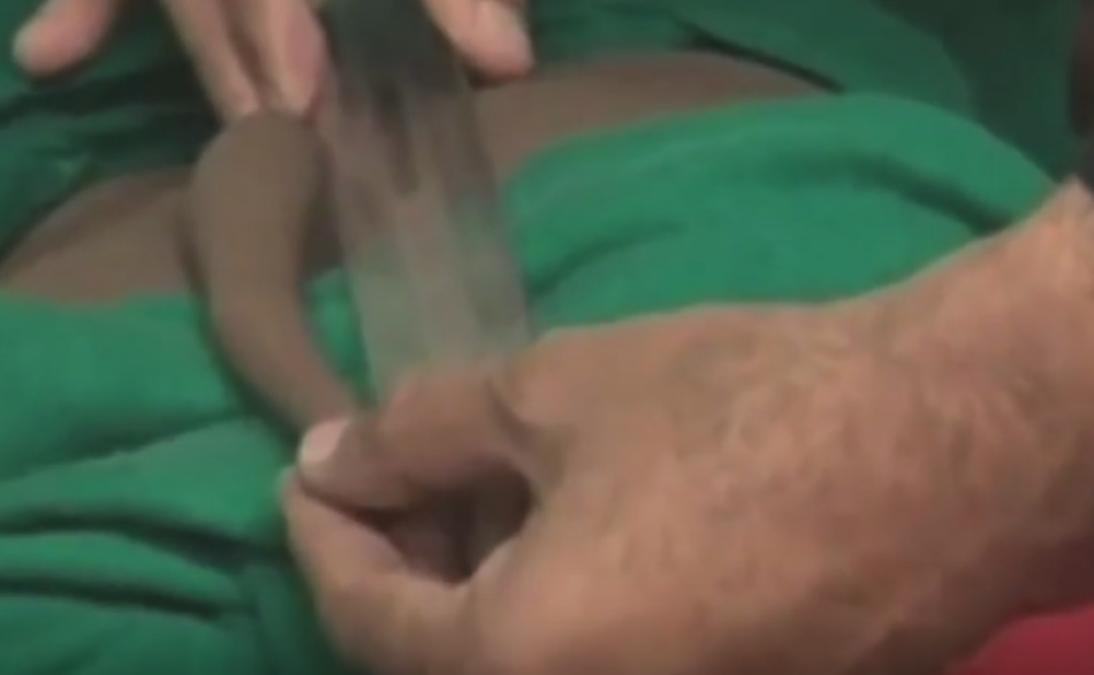 Dečaku odstranili rep od 18 centimetara! (VIDEO)