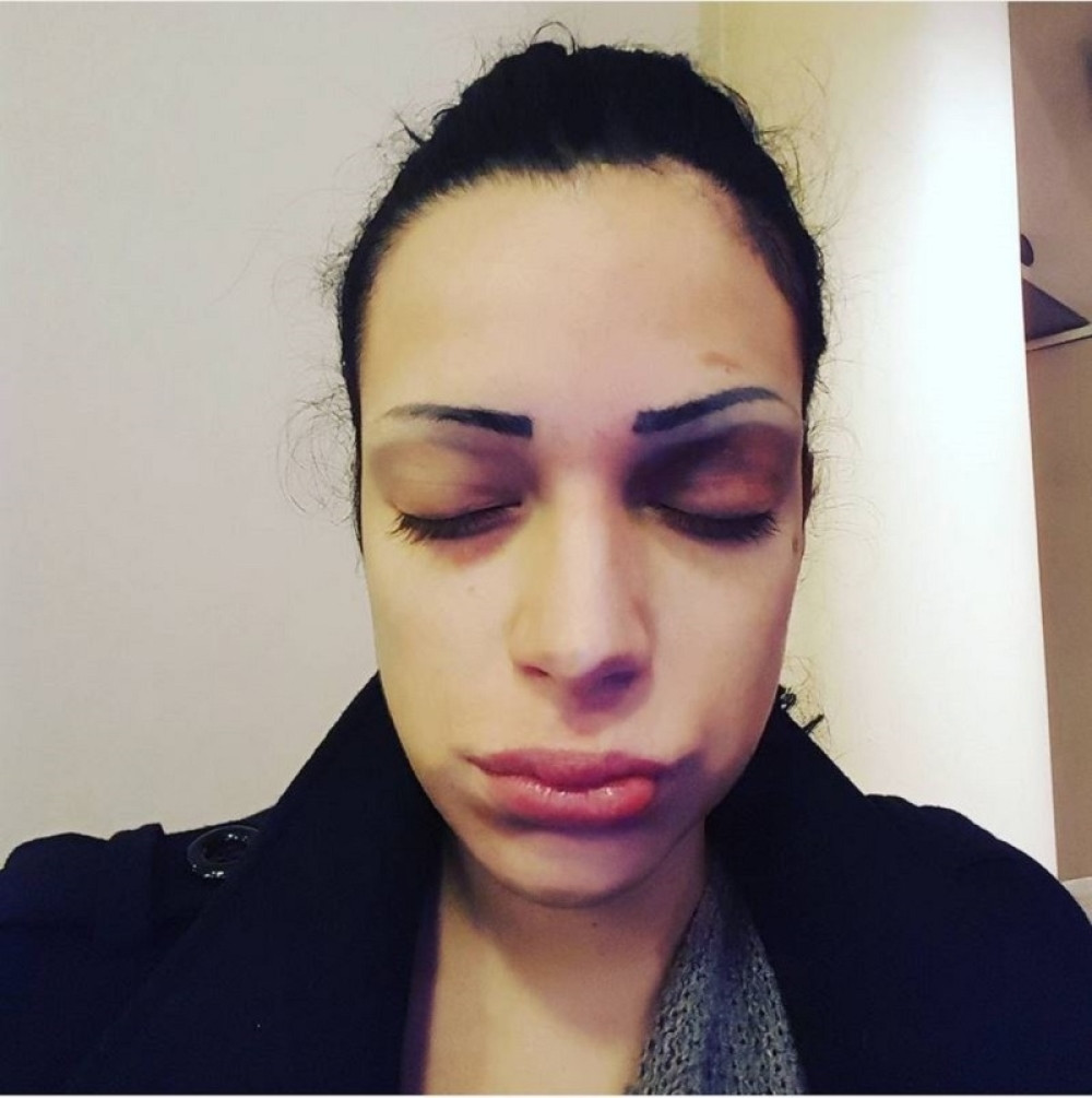 Dunja Ilić ponovo pretučena