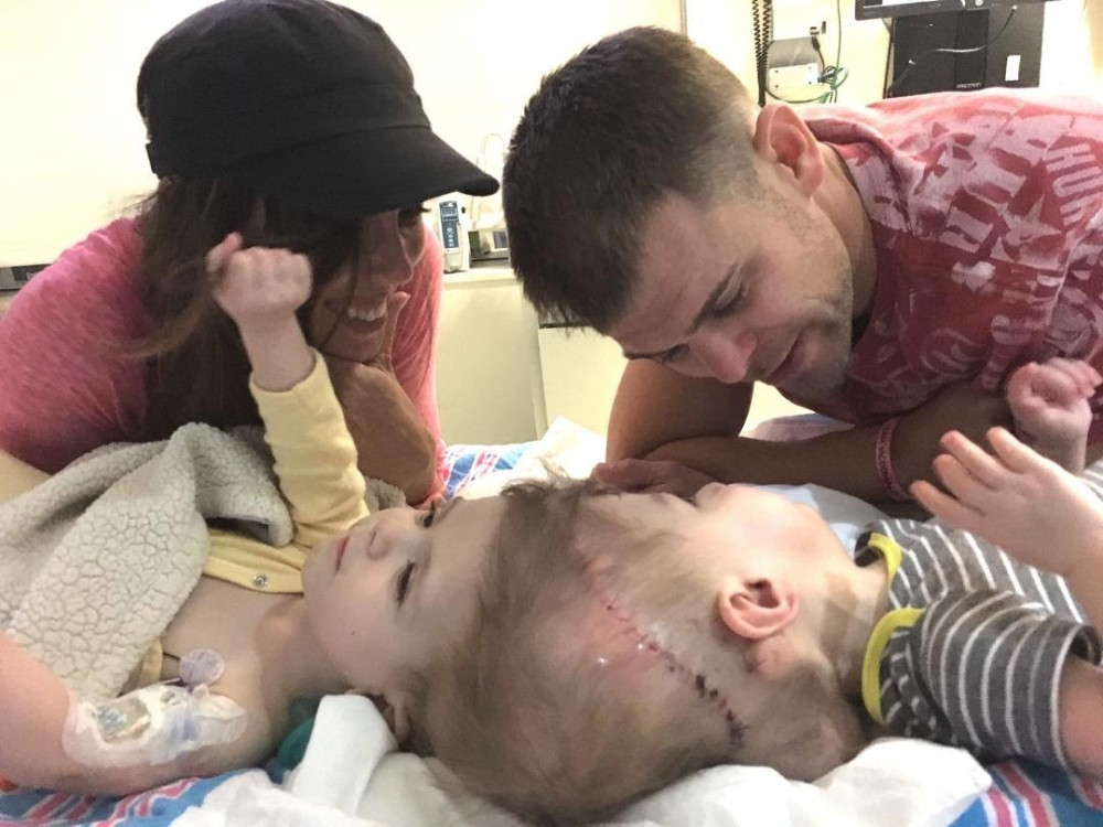 Razdvojili sijamce koji su bili spojeni glavama! (FOTO)