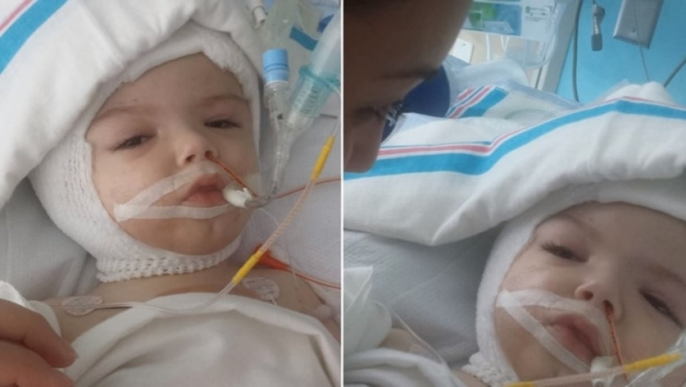 Razdvojeni sijamci otvorili oči u istom trenutku