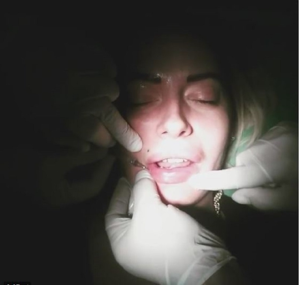 Ovako izgleda "remont" silikonskih usana! (VIDEO)