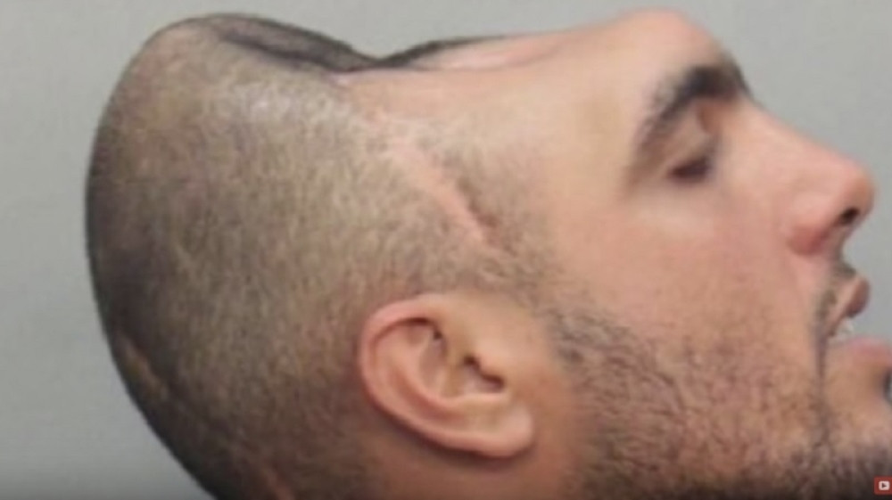 Već 14 godina živi bez pola glave! (VIDEO)