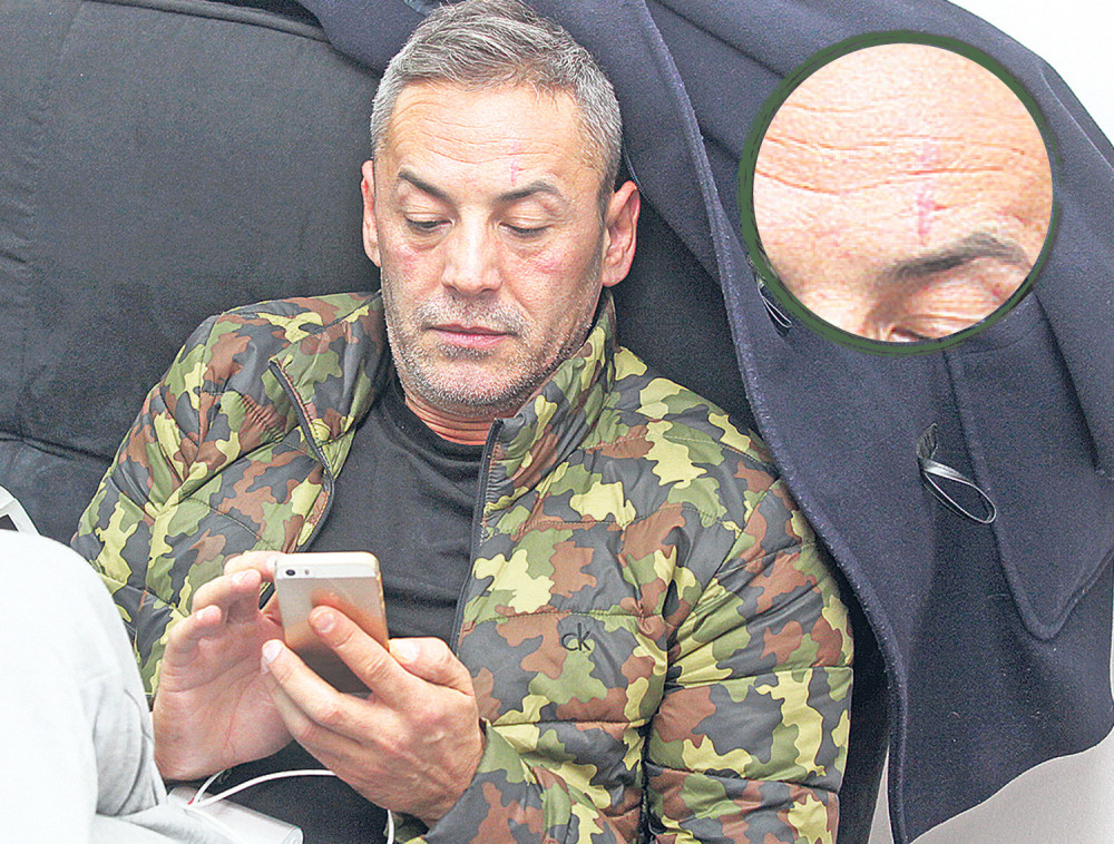 Pijan sam zaradio ožiljak na čelu