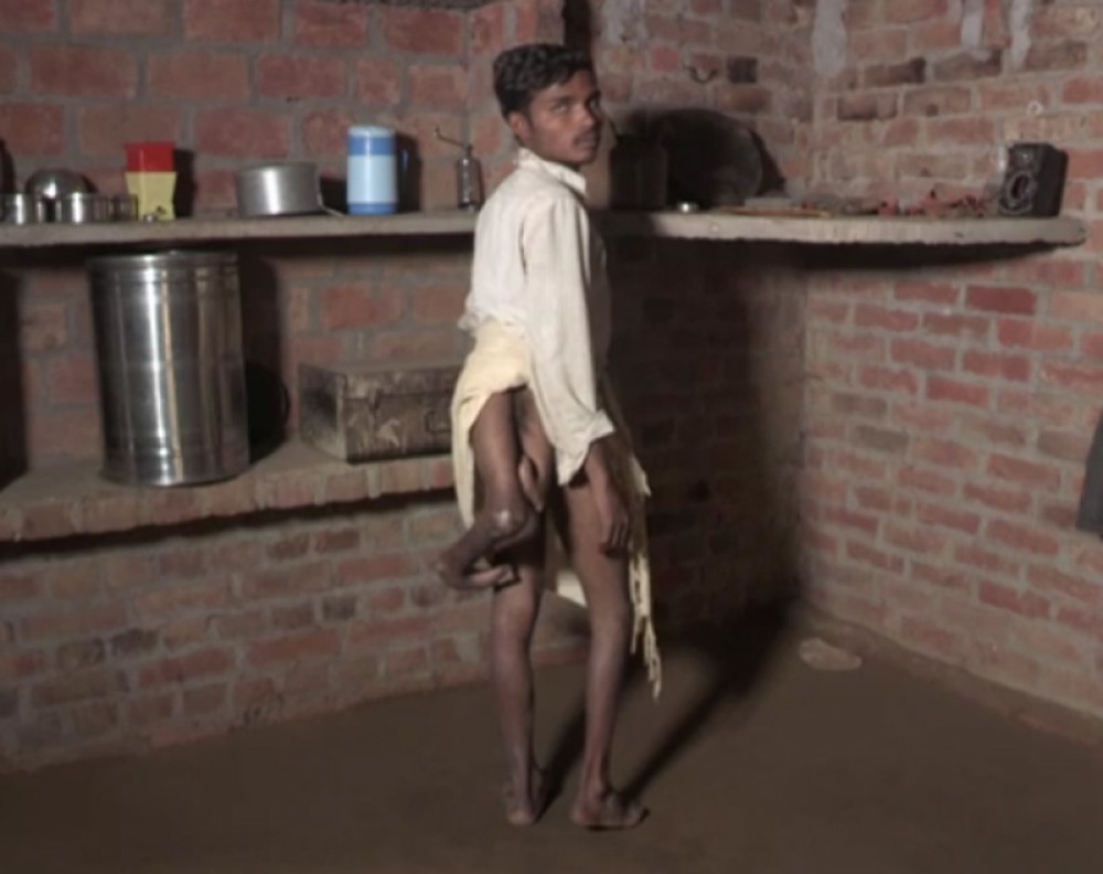 Dečak rođen sa četiri noge! (UZNEMIRUJUĆI VIDEO)