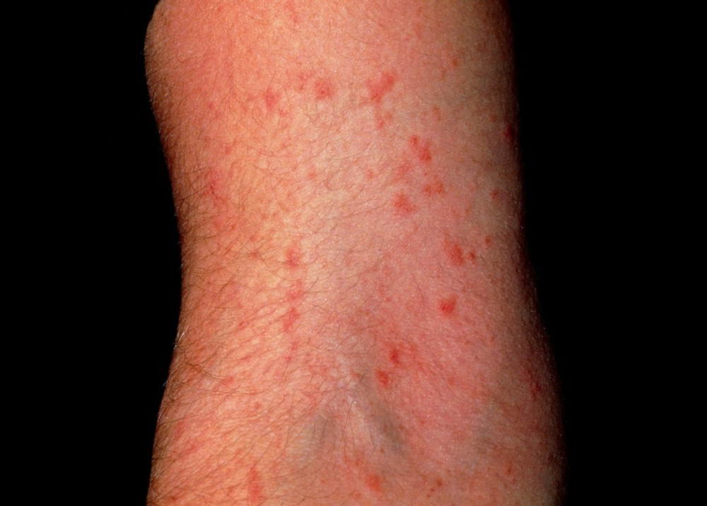 Deca iz medicinske škole obolela od šuge?