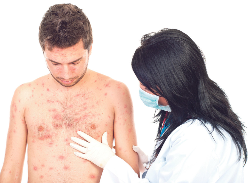 Srbin (19) primljen u bolnicu zbog boginja, hrvatski načelnik kritikovao naš sistem vakcinacije