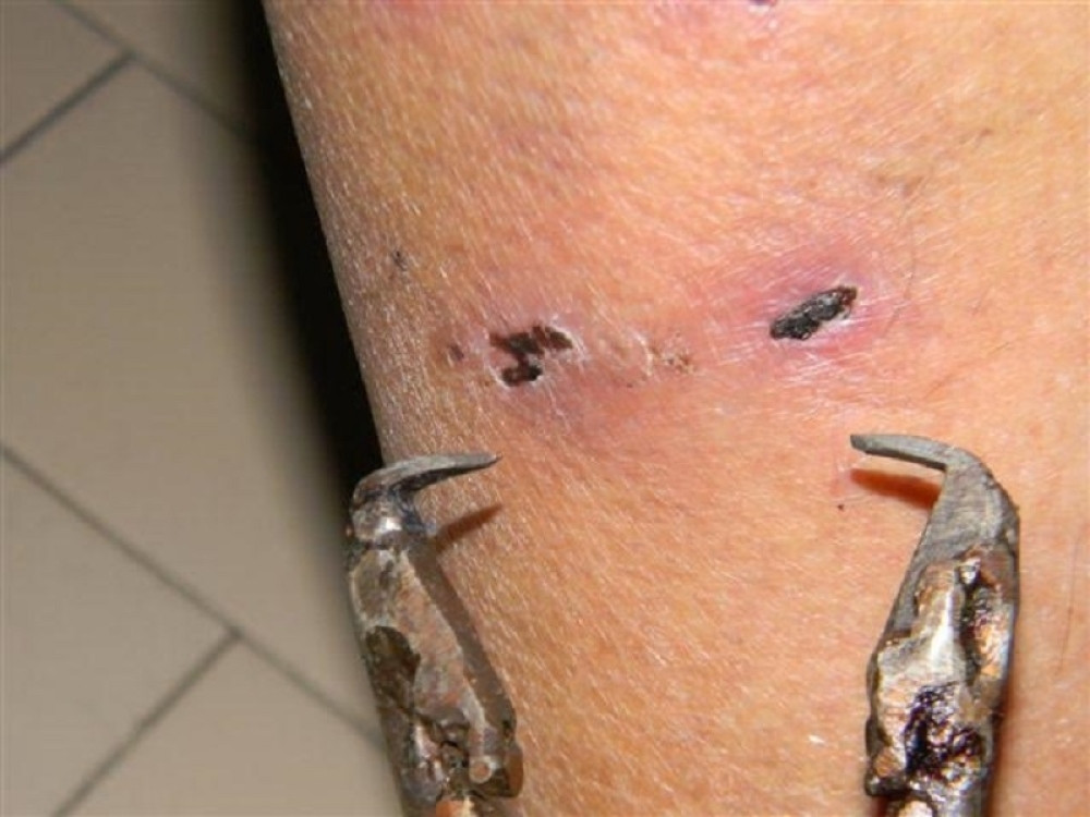 "Ujedao" ljude pod anestezijom!