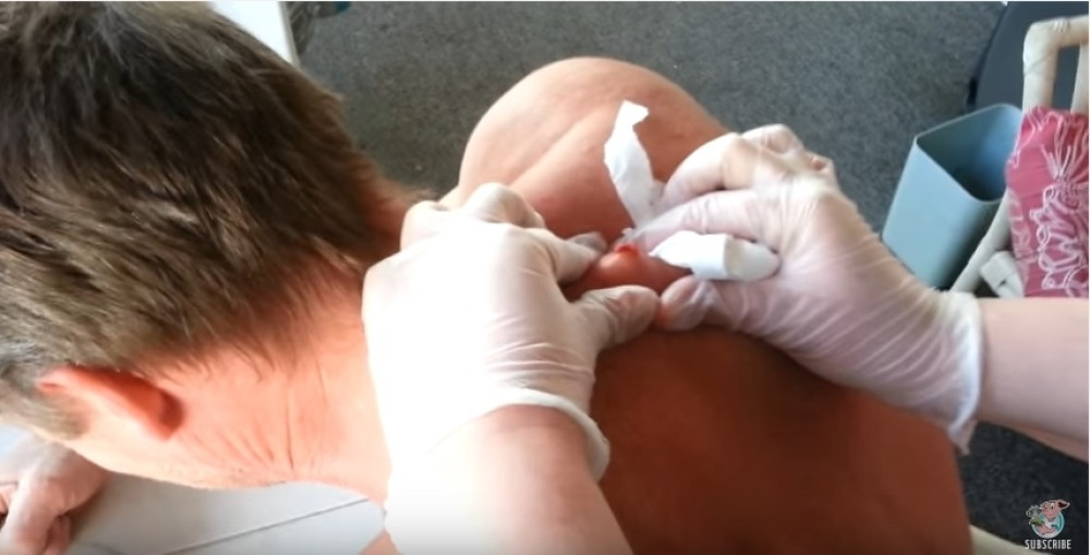 Kako je živeo sa ovolikom bubuljicom? (ODVRATAN VIDEO)