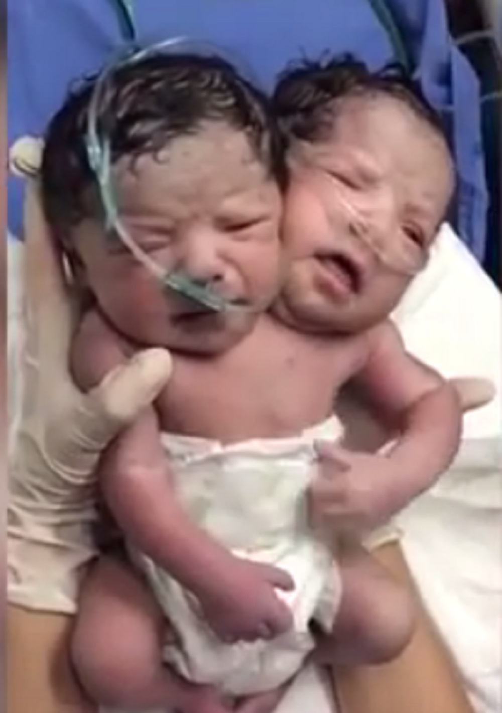 Rođena beba sa dve glave! (VIDEO)