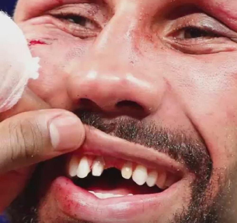 Ostao bez zuba posle meča (VIDEO)