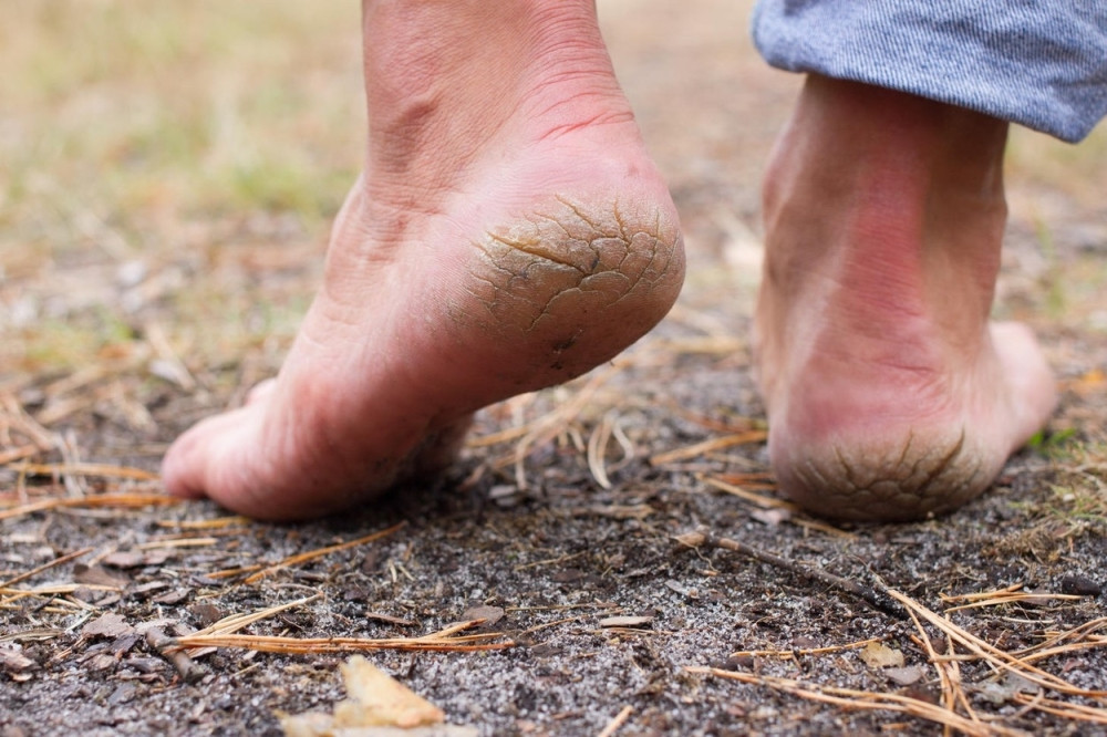 Rešite problem suvih i ispucalih peta