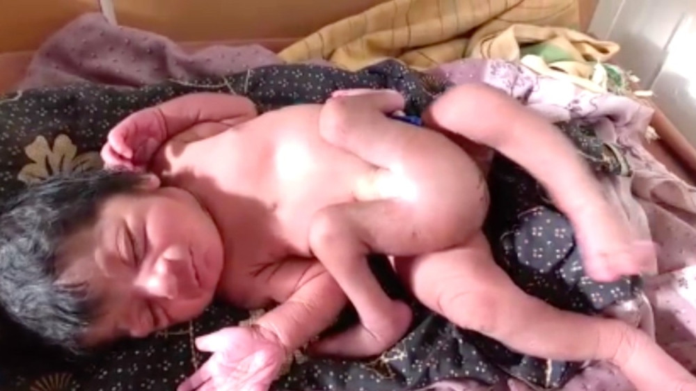 Dete rođeno sa četiri noge i dva penisa (UZNEMIRUJUĆI VIDEO)