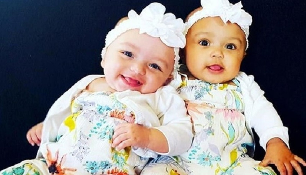 One su bliznakinje, ali različite boje kože