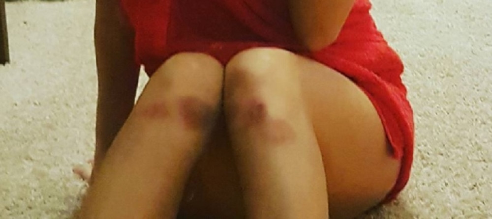 Pevačica Nives Celzijus krvava, sva u zavojima i gipsu! Niko ne zna šta joj se desilo