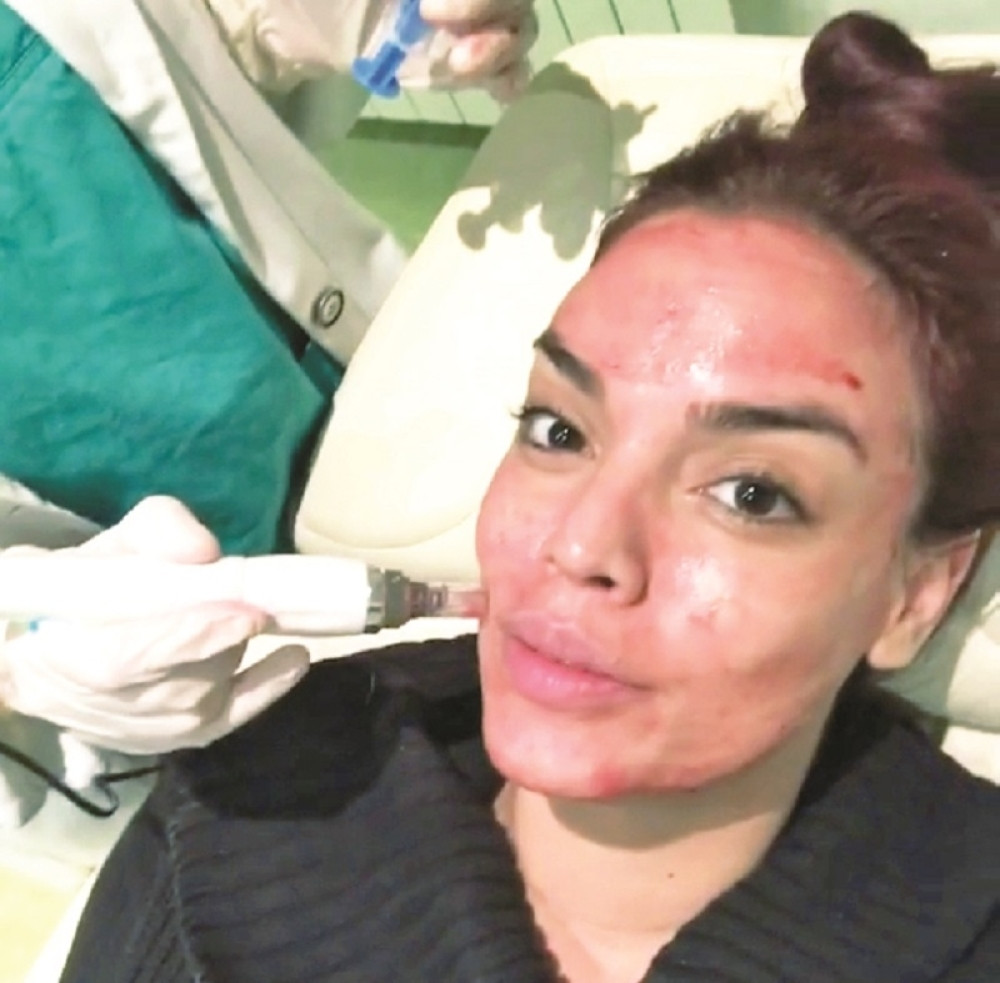 Sofija se ulepšava pomoću krvi