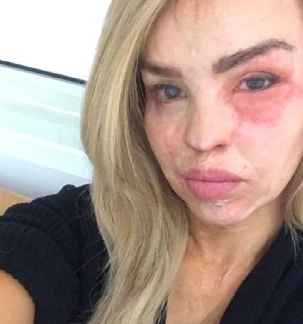 Dečko joj sipao kiselinu u lice, danas izgleda OVAKO (FOTO)