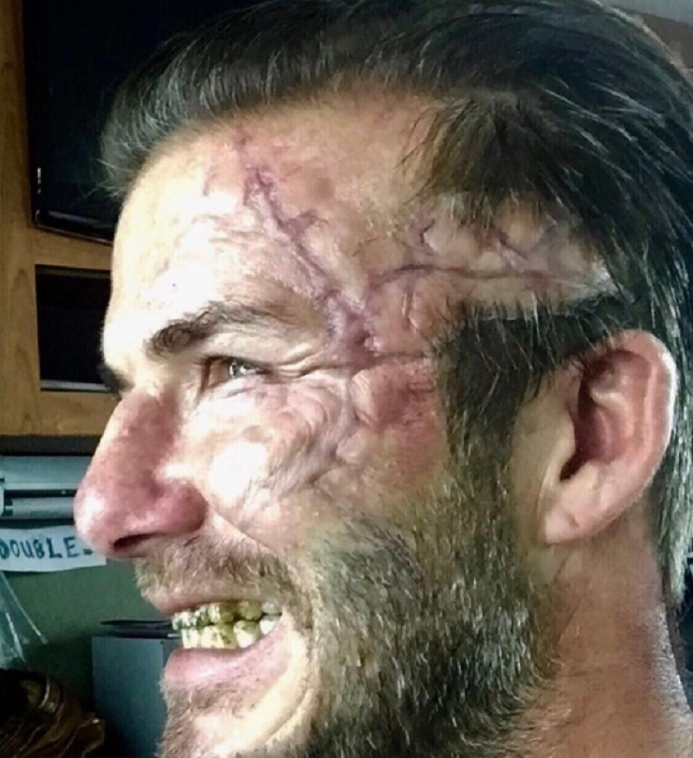 Bekamu unakazili lice (FOTO)