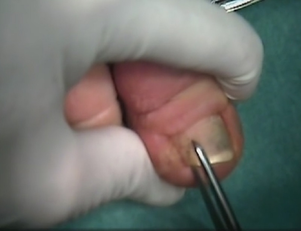 Dugo se mučila sa uraslim noktom, sve dok nije pronašla ovaj LEK!