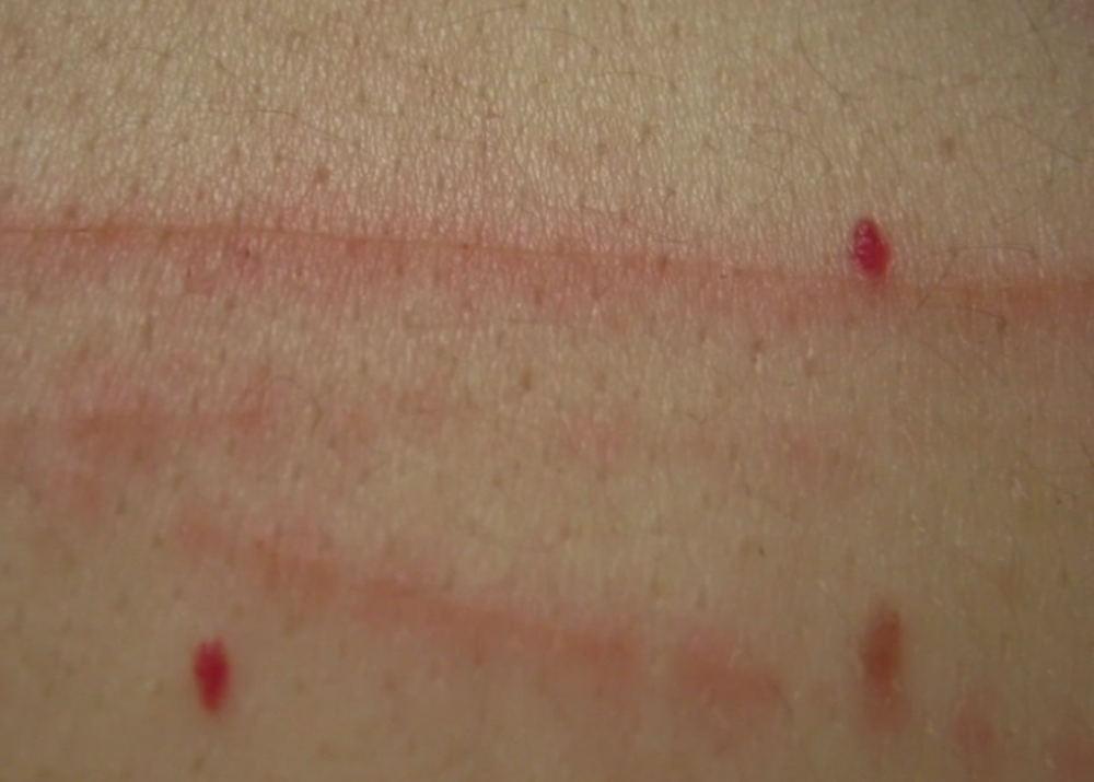 Da li na koži imate ovakve crvene tačkice? Evo zašto...